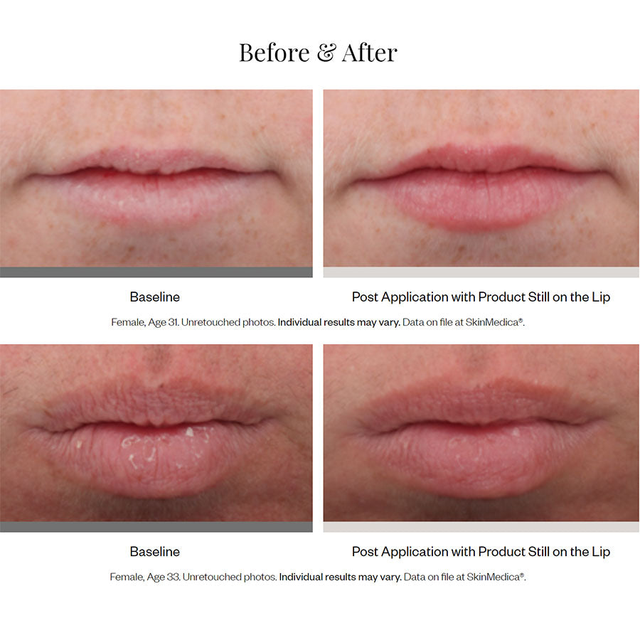 SkinMedica HA5 Smooth and Plump Lip System Before and After