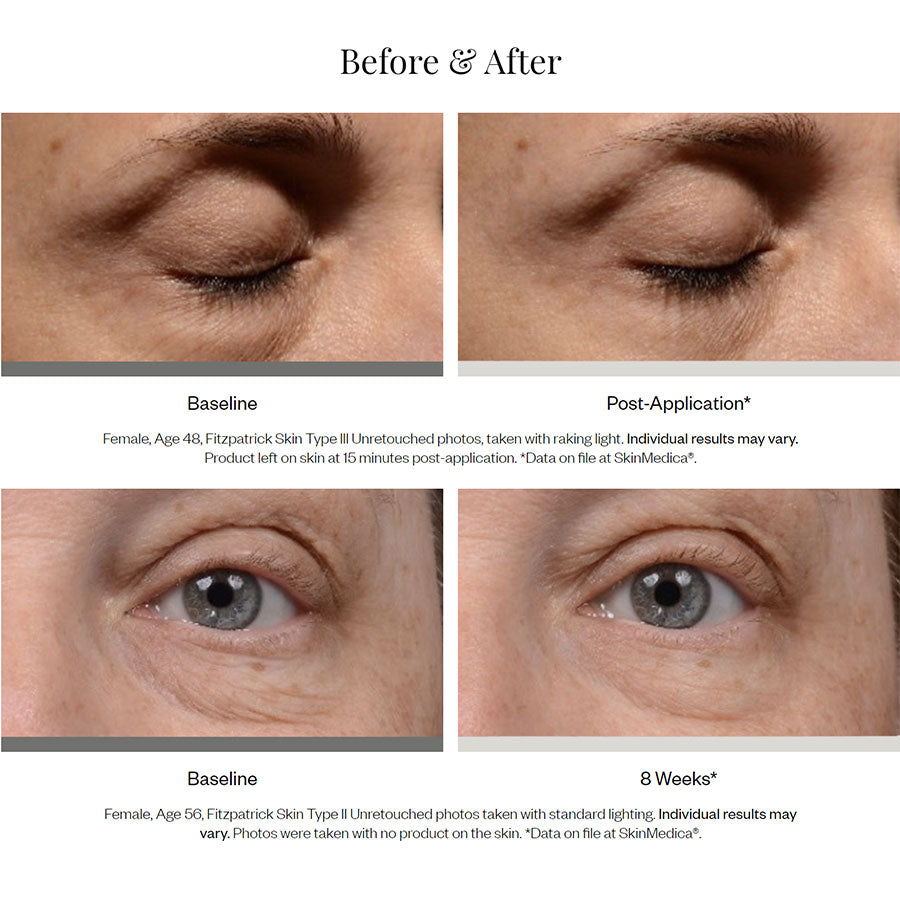 SkinMedica Instant Bright Eye Cream Before and After