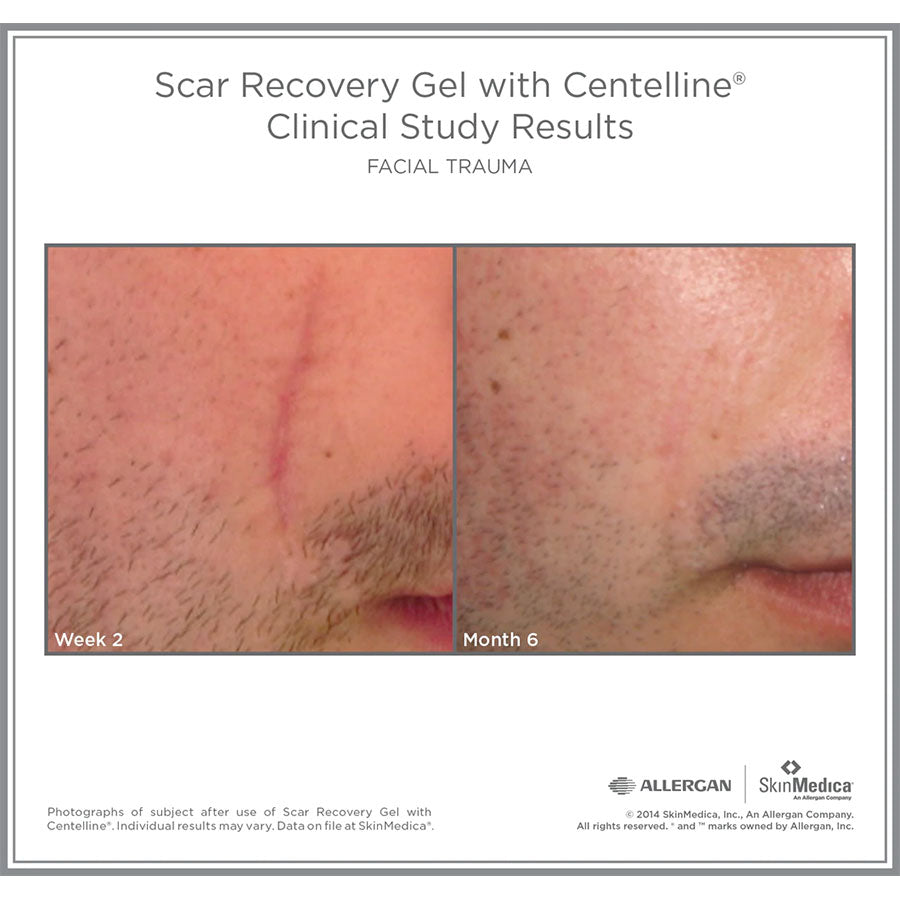 SkinMedica Scar Recovery Gel with Centelline Before and After