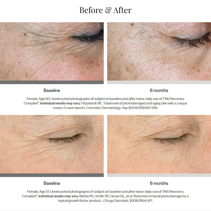 SkinMedica TNS Recovery Complex Before and After
