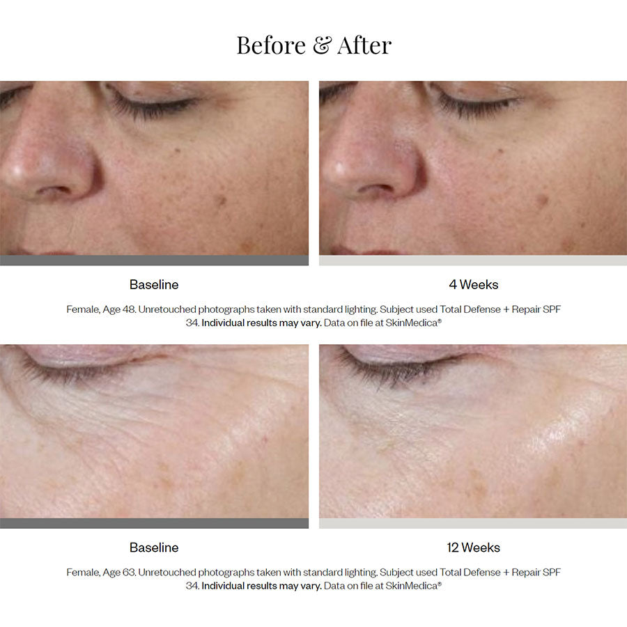 SkinMedica Total Defense + Repair Broad Spectrum SPF 34 / PA++++ Sunscreen Before and After
