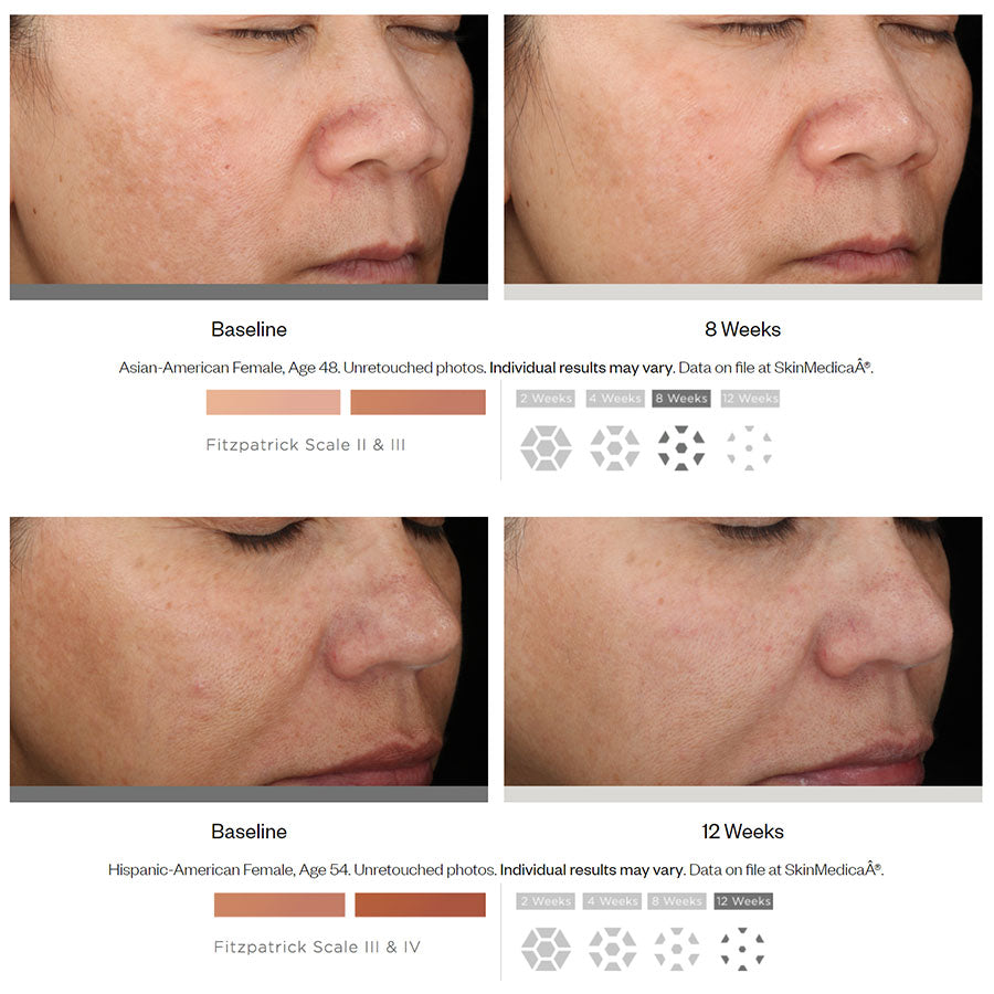 Does SkinMedica Lytera 2.0 Pigment Correcting Serum work? Before and after photos