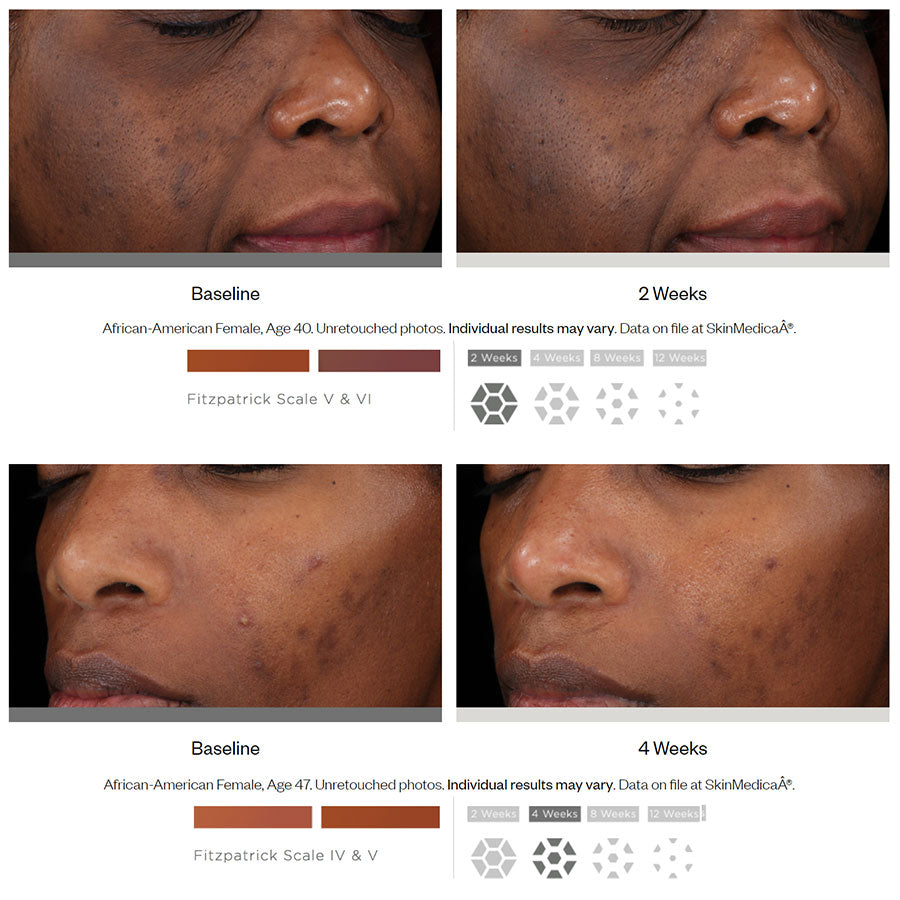 Does SkinMedica Lytera 2.0 Pigment Correcting Serum work? Before and after photos